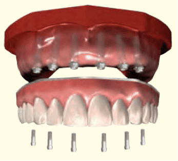 dental-implant-denture-1