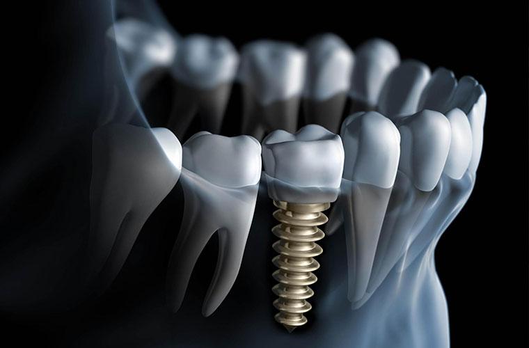 Dental Implants in Rochester NY