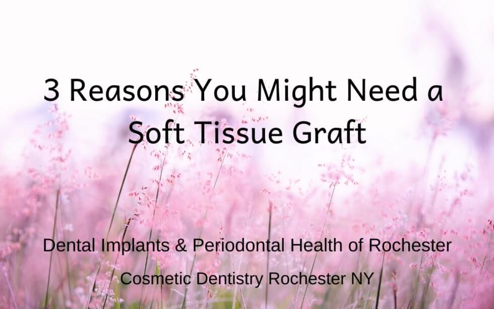 3 Reasons You Might Need a Soft Tissue Graft: Cosmetic Dentistry in Rochester NY