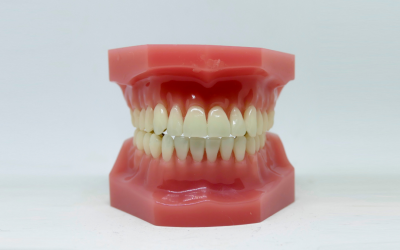 Tooth Replacement Rochester NY Offers Dental Implants for Missing Teeth