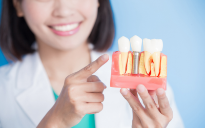 How Many Dental Implants Can Be Placed At One Time?