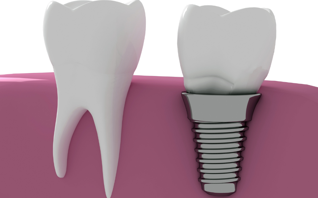 Bone Grafting and Dental Implants