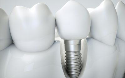Do Dental Implants Stain Like Natural Teeth?