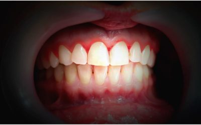 Four Common Causes of a Gummy Smile