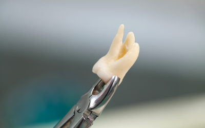 Why You May Need a Tooth Extraction Even If There’s No Pain