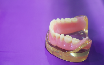 How Long Do Implant-Supported Dentures Last From a Rochester, NY, Periodontist?