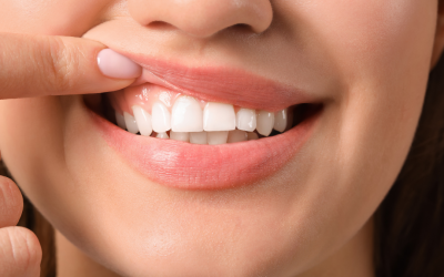 Is Gum Recession a Serious Problem?