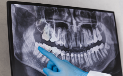 Signs and Symptoms of Wisdom Tooth Eruption