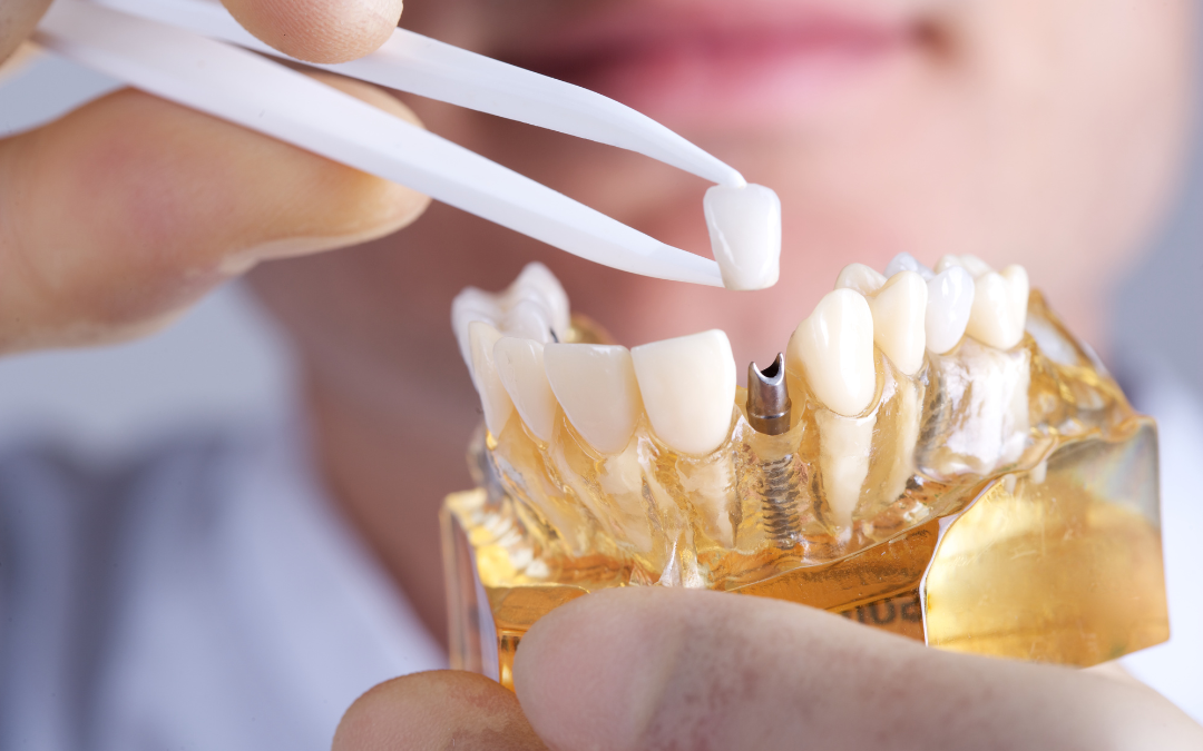 Is It Better to Have Dentures or Dental Implants