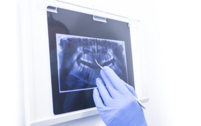What to Expect with Bone Graft Recovery