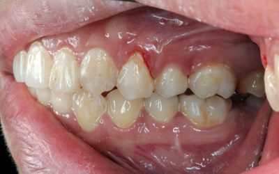 When to Seek Treatment for Gum Recession in Rochester