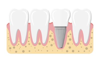 Dental Implant Timeline