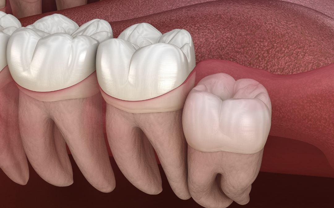 Wisdom Teeth Removal — What to Expect During Recovery