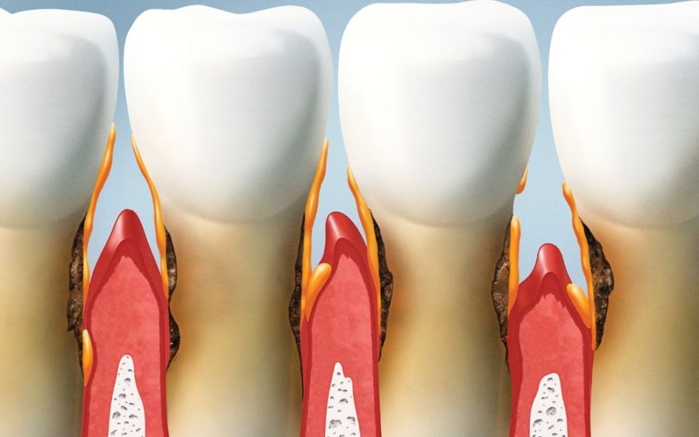 Gum Grafting What It Is, Procedure, and Recovery
