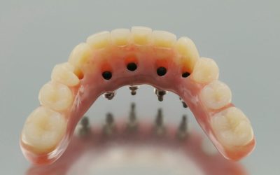 Pros and Cons of Implant-Supported Dentures