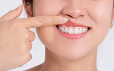What Happens When You Need Gum Recession Care in Rochester?