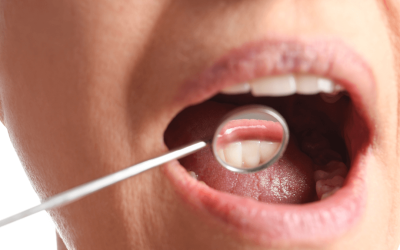 Periodontist in Rochester Answers – Can You Reverse Gum Recession?