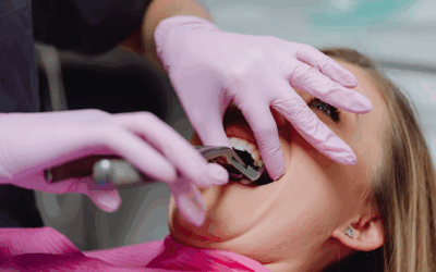 Missing Teeth in Rochester? Discover Your Best Tooth Replacement Options