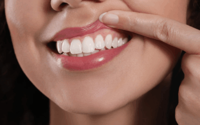 How to Prevent Gum Recession and Maintain Healthy Gums in Rochester