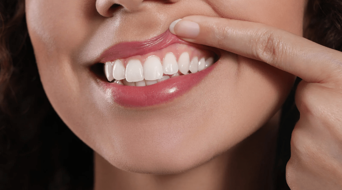 Prevent gum recession in Rochester