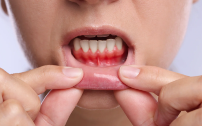 Teeth Grinding and Gum Recession: A Hidden Cause of Gum Damage