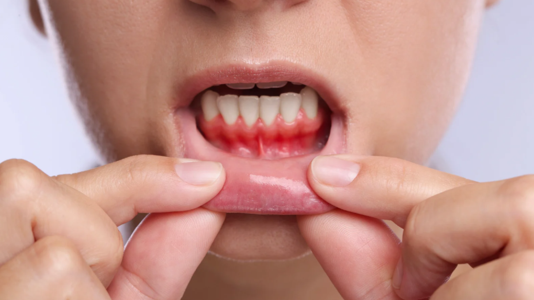 Teeth Grinding and Gum Recession