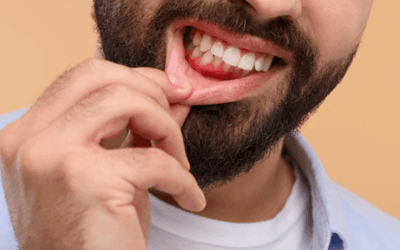 What Causes Gum Recession? Early Warning Signs Rochester Patients Shouldn’t Ignore