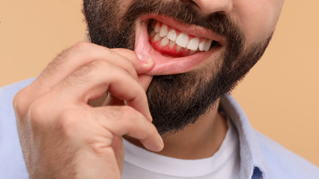 What Causes Gum Recession-Early Warning Signs Rochester Patients Shouldn't Ignore