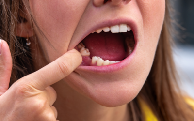 What Happens If You Don’t Replace a Missing Tooth?