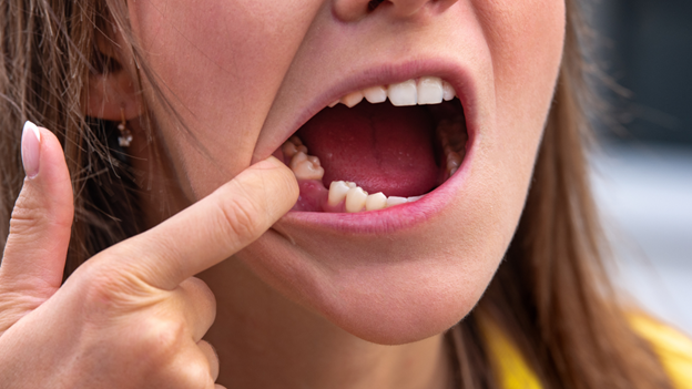 What Happens If You Don't Replace a Missing Tooth?
